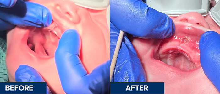 Frenectomy_Before&After_Ava._labial