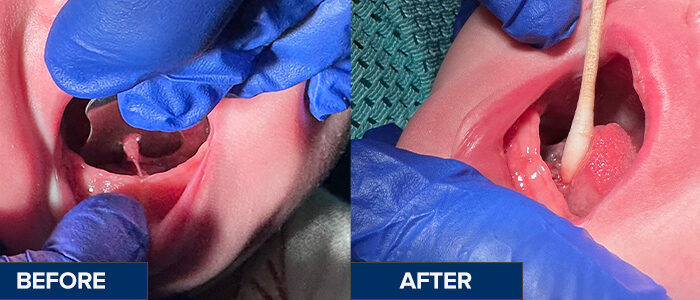 Frenectomy_Before&After_Ava_Ligual