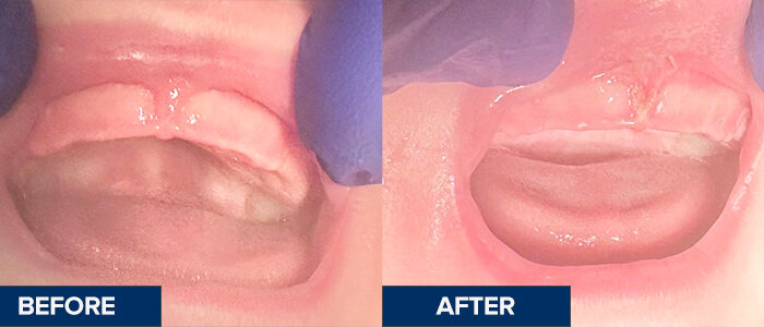 Frenectomy_Before&After_Elyna._labial