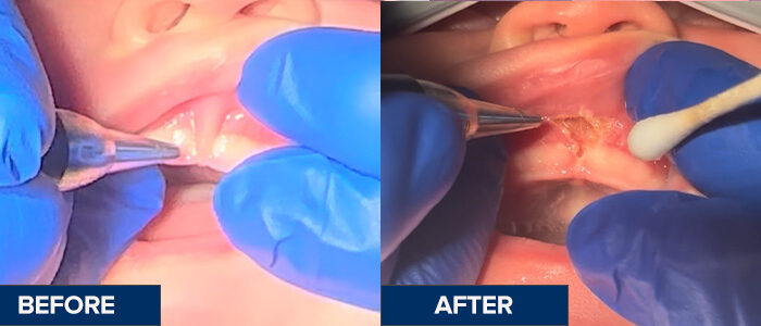 Frenectomy_Before&After_Jamison_Labial