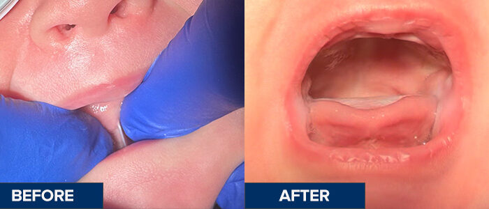 Frenectomy_Before&After_Jamison_Ligual