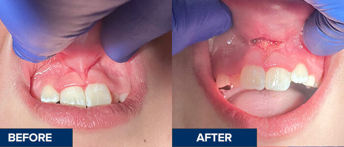 Frenectomy_Before&After_Jaxson_Labial